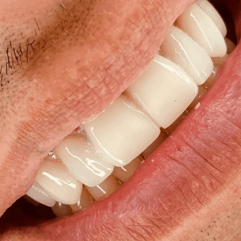 Antes y Después de Carillas dentales